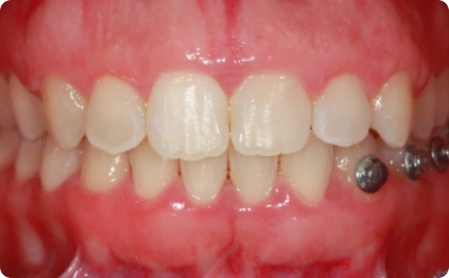Sorriso gengival (1)