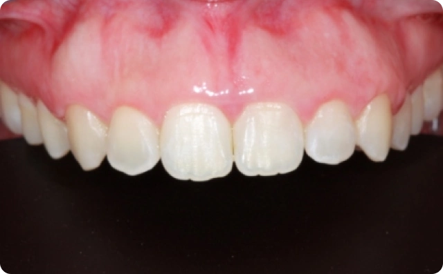 Sorriso gengival (2)
