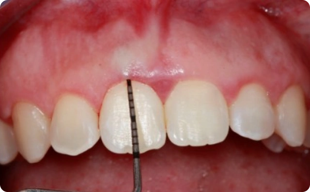 Sorriso gengival (3)