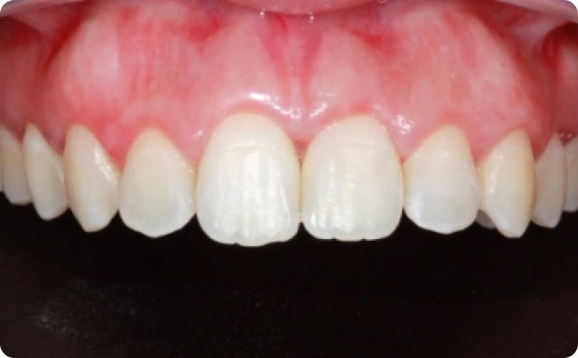 Sorriso gengival (5)