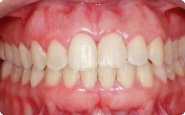 Sorriso gengival (6)