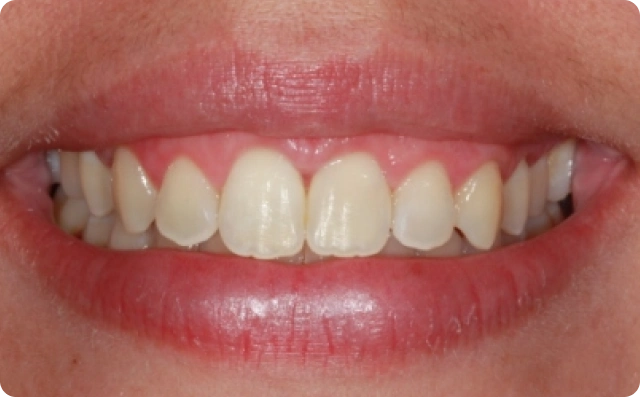 Sorriso gengival (7)