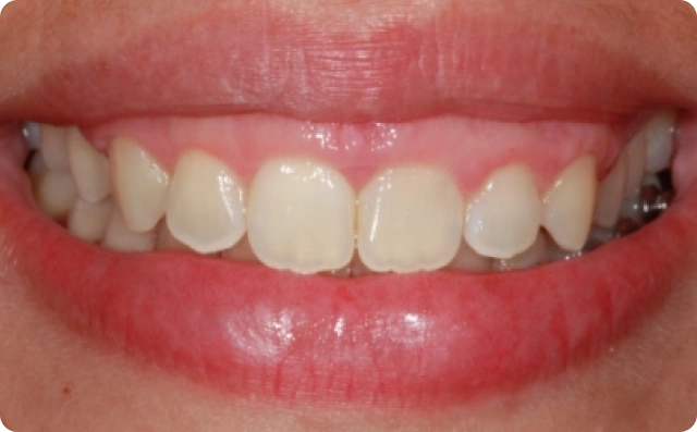Sorriso gengival (8)