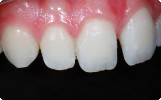 fechamento de dentes (1)