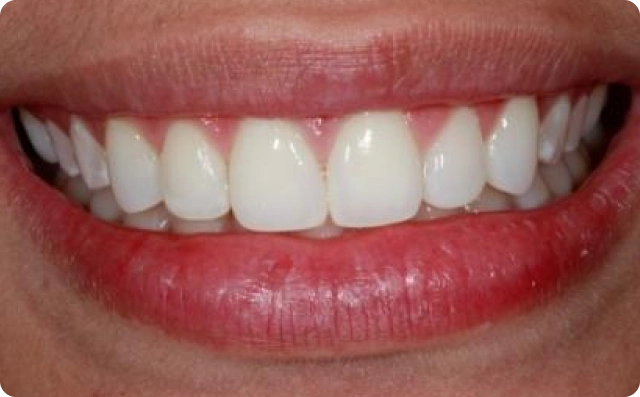fechamento de dentes (2)