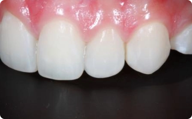 fechamento de dentes (3)