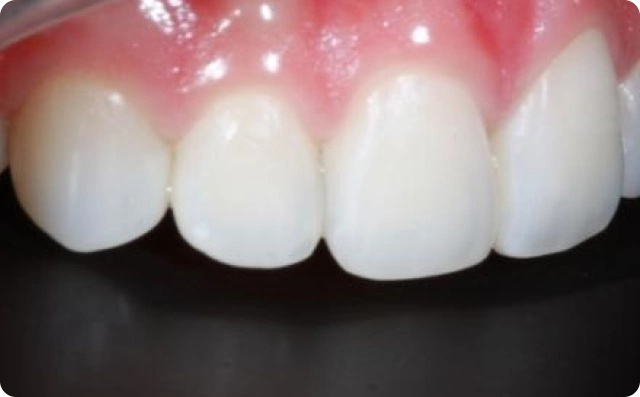 fechamento de dentes (4)