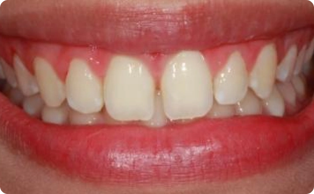fechamento de dentes (5)