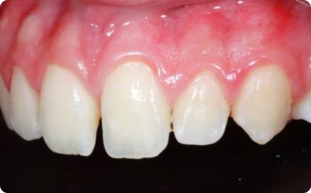 fechamento de dentes (6)